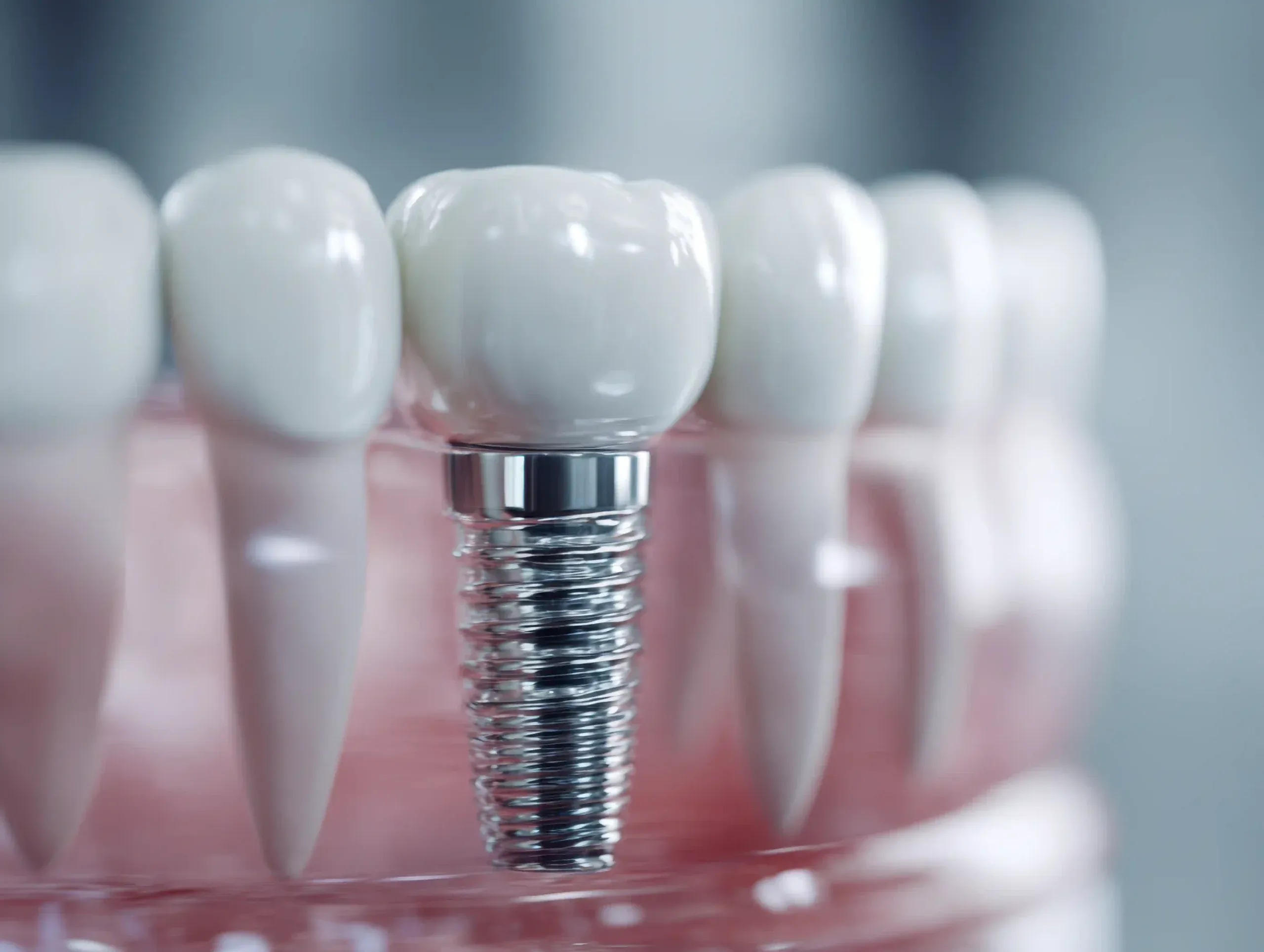 Implantáció és Szájsebészet